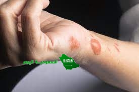 تحدث الحروق الكيميائية بسبب التعرض بيت العلم